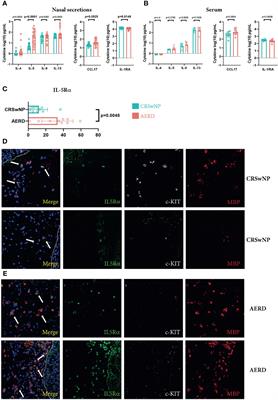 Comprehensive Analysis of Nasal Polyps Reveals a More Pronounced Type 2 Transcriptomic Profile of Epithelial Cells and Mast Cells in Aspirin-Exacerbated Respiratory Disease